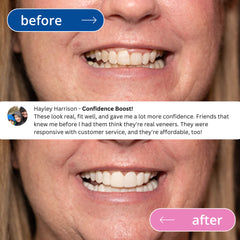 TruSmile Custom Made Veneers Demo