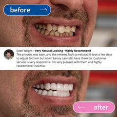 TruSmile Custom Made Veneers Demo