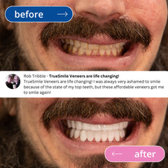 TruSmile Custom Made Veneers Demo