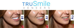 TruSmile Custom Made Veneers ( 1 Single Payment )